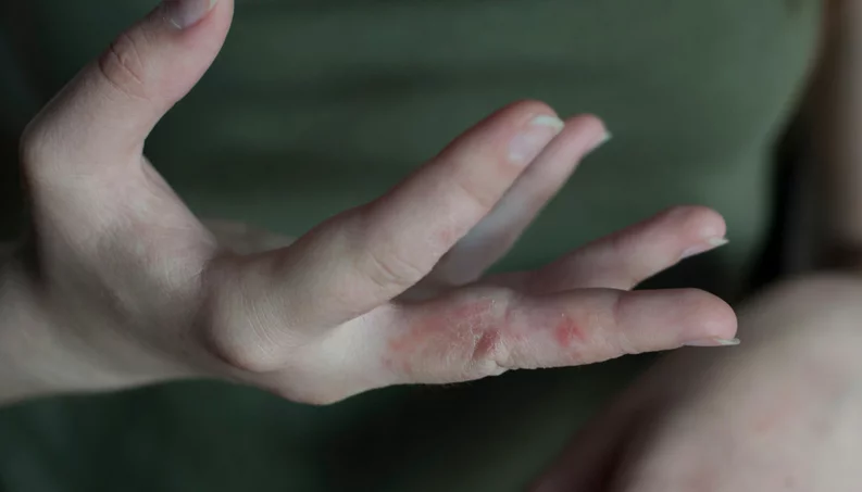Coceira no corpo à noite pode ser escabiose: o que é e como tratar