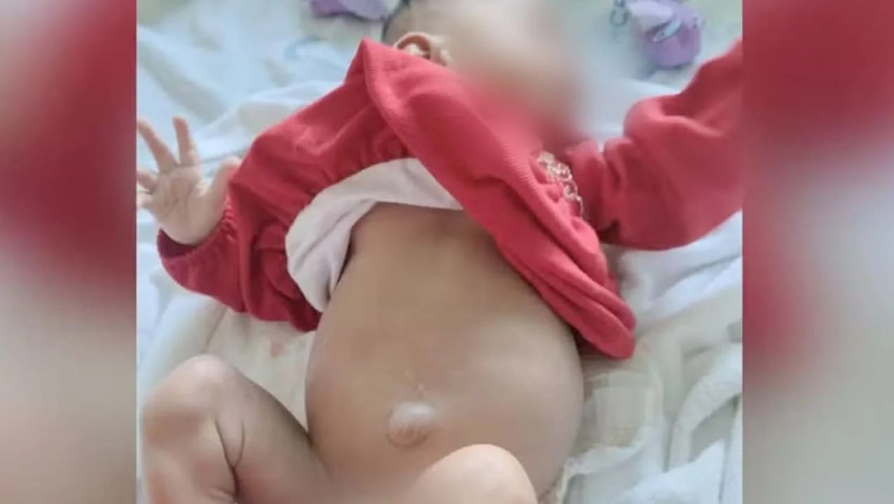 Bebê nasce com 4 rins em Goiás e é considerado caso raro no mundo; entenda