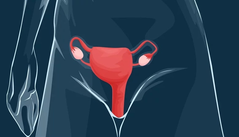 Câncer de endométrio tem mais chance de aparecer em mulheres com 6 condições