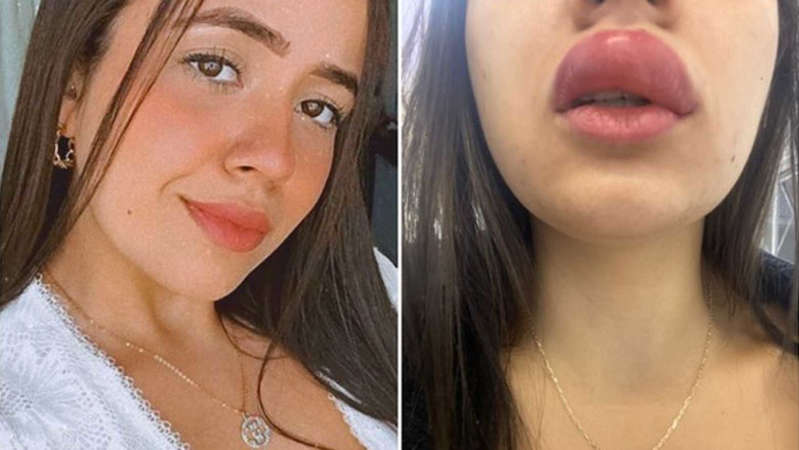 Estudante fica com lábio gigante ao ser picada por lacraia enquanto dormia