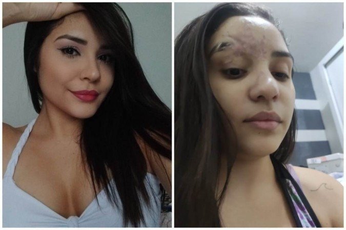 Estudante passará por nova cirurgia após acidente que deixou sequelas no rosto