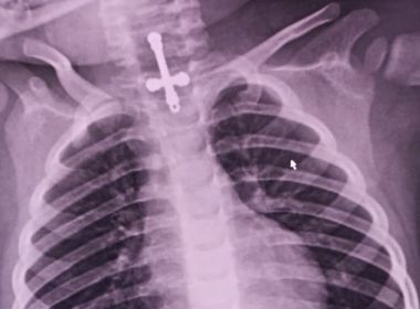 Menino de 2 anos engole crucifixo que é retirado após intervenção médica