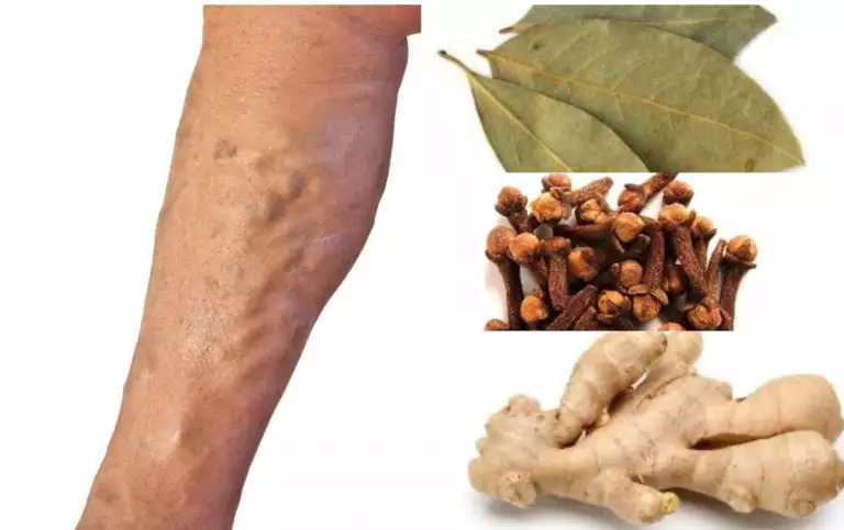 Tratamento natural para varizes com folha de louro, cravo-da-índia e gengibre