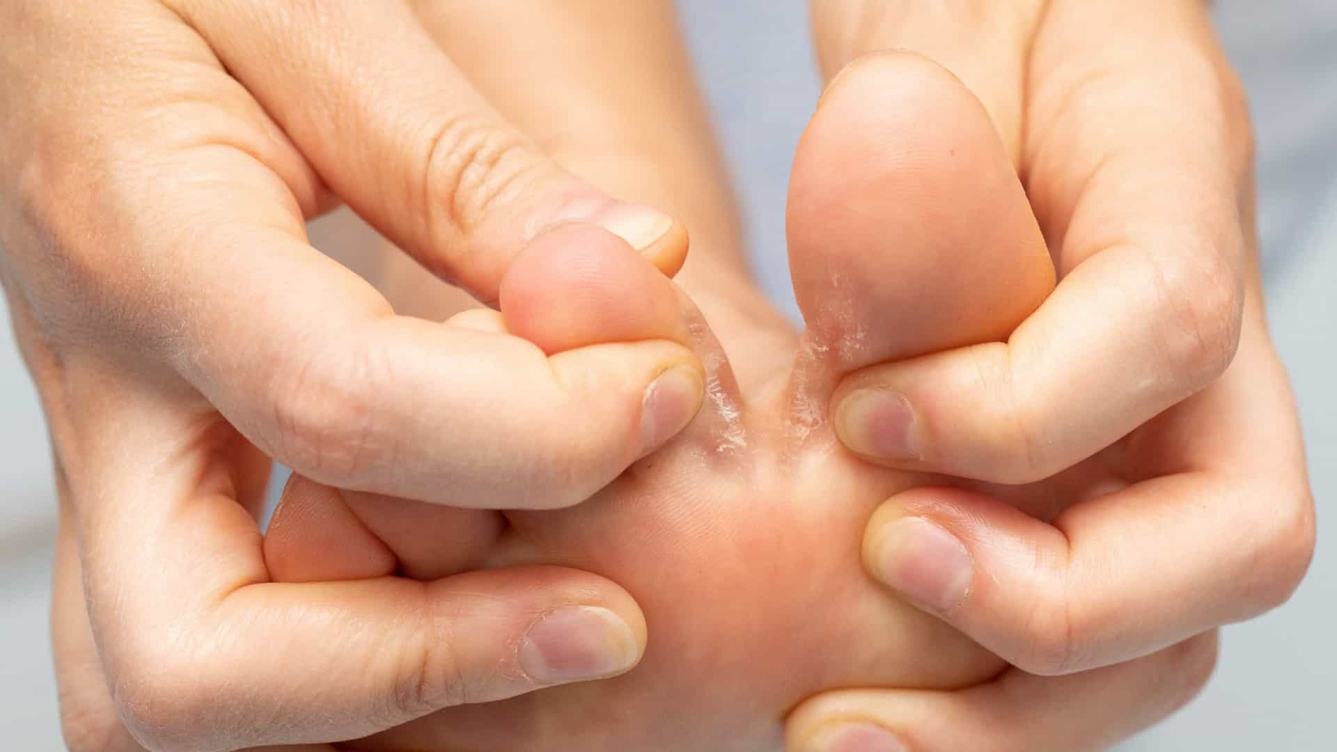 Três infecções que pode pegar na academia e como evitar